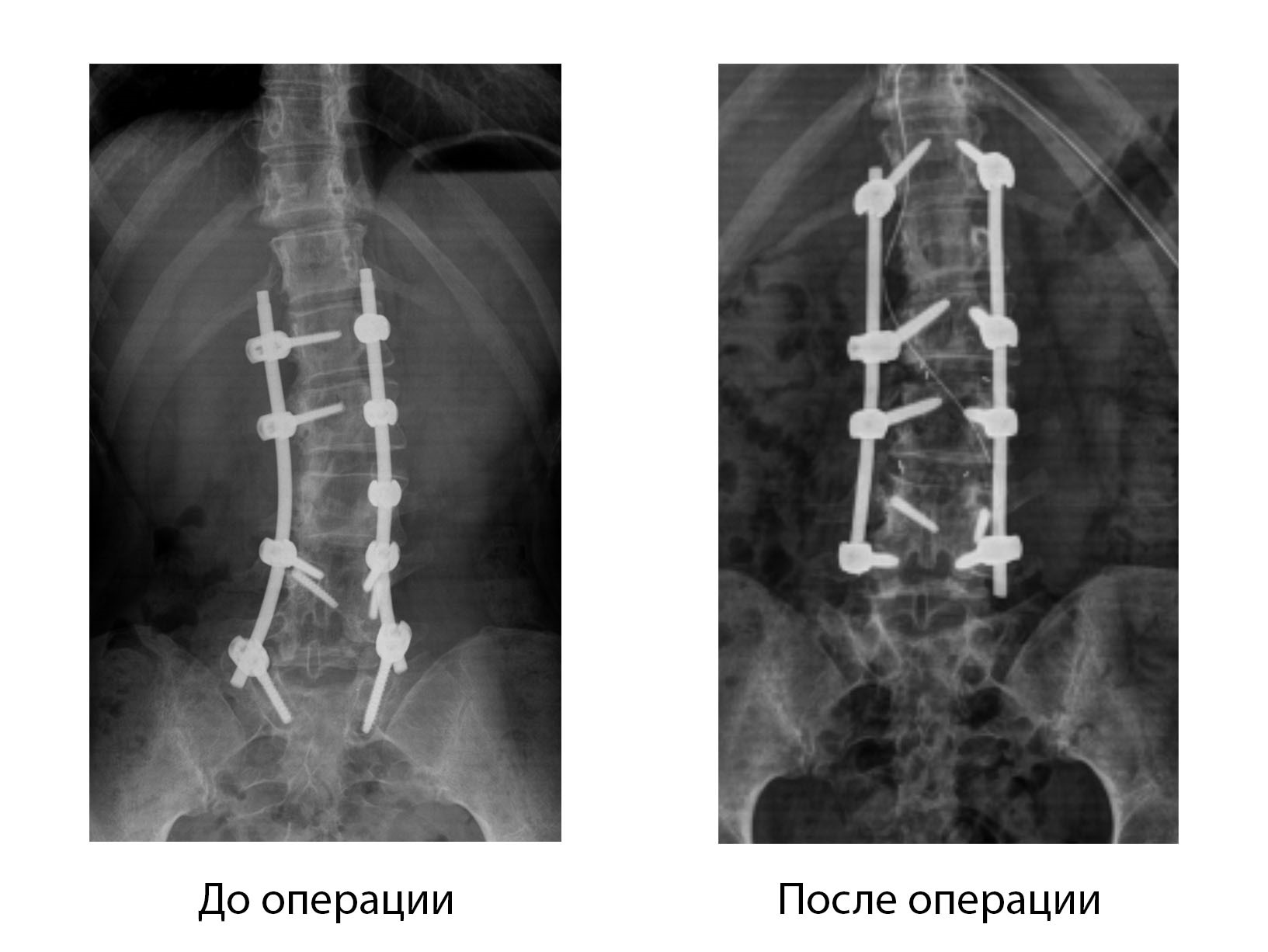 В Центре хирургии позвоночника провели коррекцию сколиоза пациентке после предшествующих множественных операций