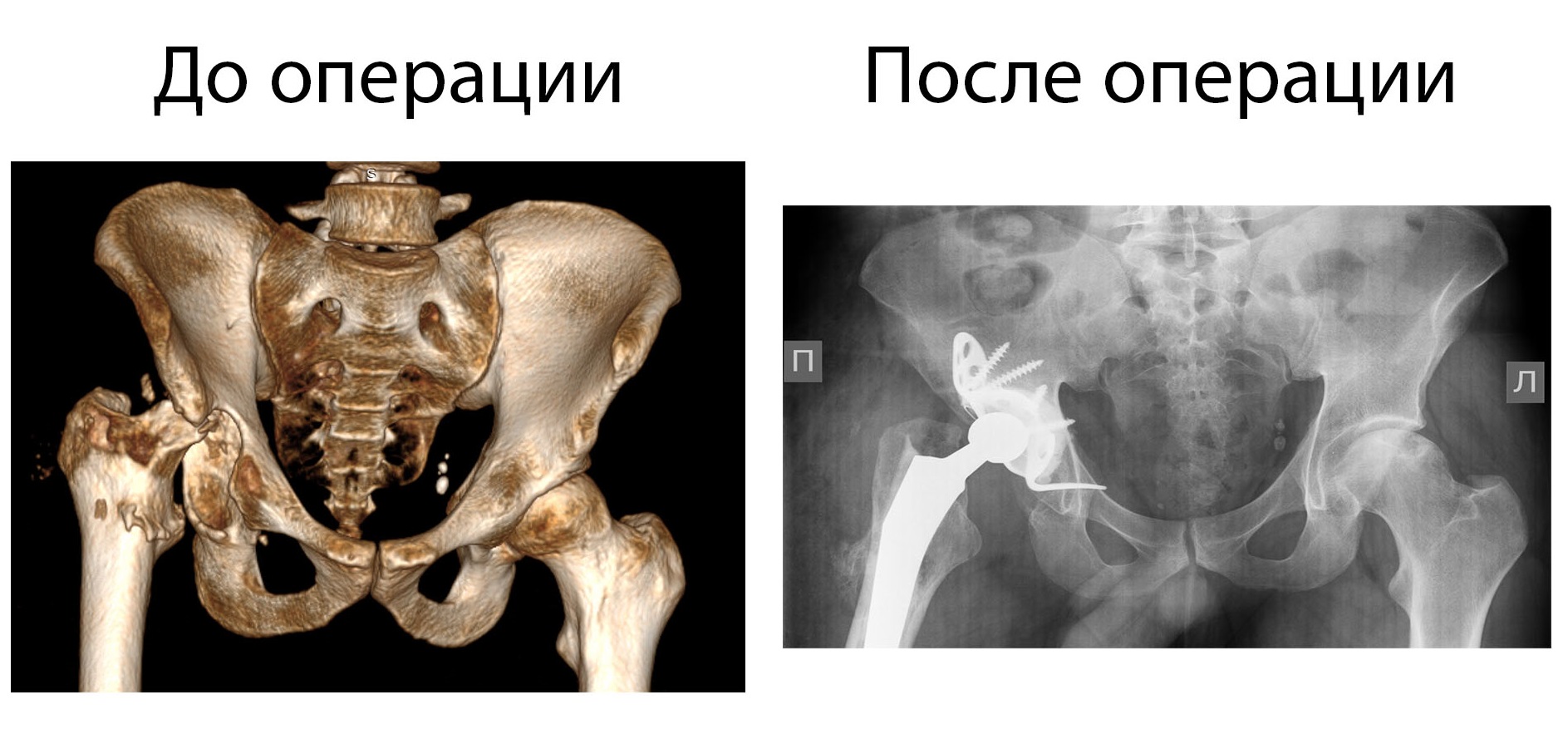 Врачи СПб НИИФ провели имплантацию эндопротеза тазобедренного сустава