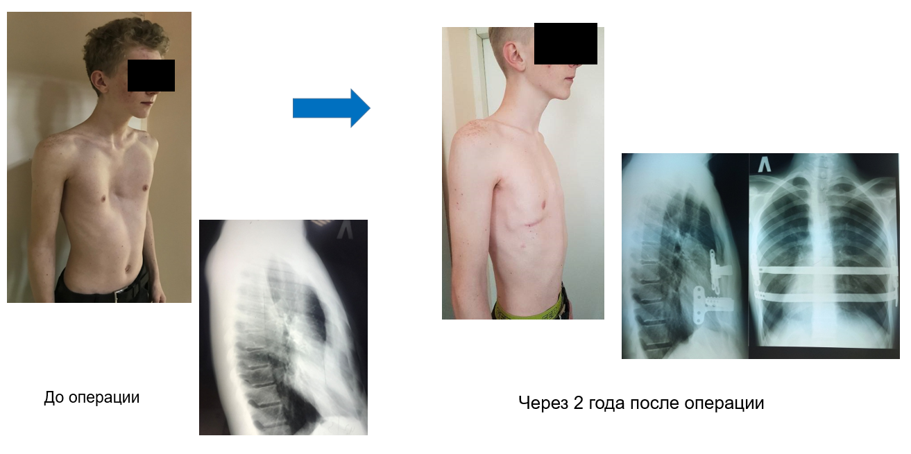 Проведение торакопластики по Нассу в ФГБУ "СПб НИИФ"